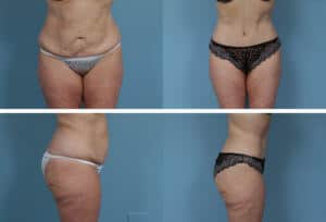 tummy-tuck-1