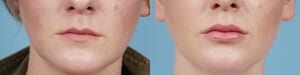 Plump lips