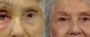eyelid-repair