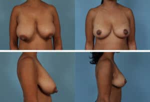 Breast Reduction Amman