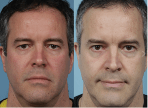Male Eyelid Surgery Chicago