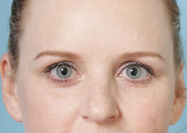 C-Angle blepharoplasty